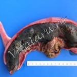 Figura 2. Ruptură uterină pe mica curbură în regiunea placentaţiei şi ruptură abdominală fetală cu eviscerare ulterioară a intestinului